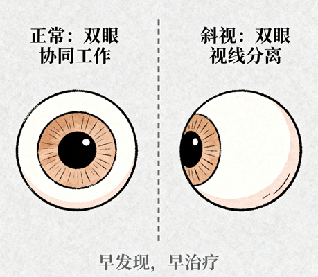斜弱视不可忽视：孩子视力的隐形杀手